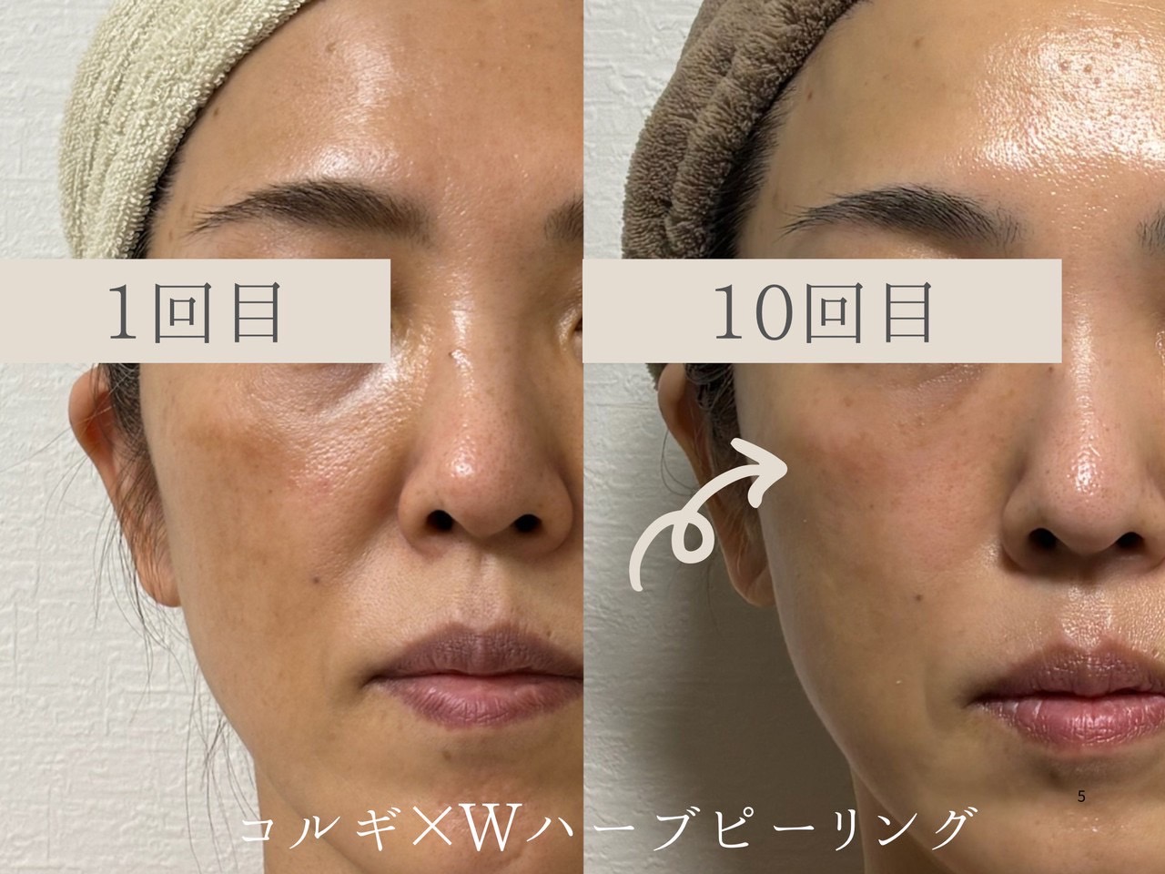 ハーブピーリング施術例 1回目と10回目